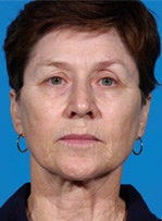 Laser resurfacing-Erbium ablative resurfacing