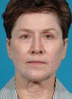 Laser resurfacing-Erbium ablative resurfacing