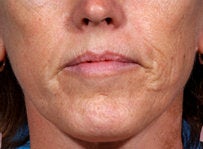 Laser resurfacing-Erbium ablative resurfacing
