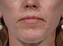 Laser resurfacing-Erbium ablative resurfacing