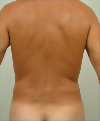 Laser Liposuction 