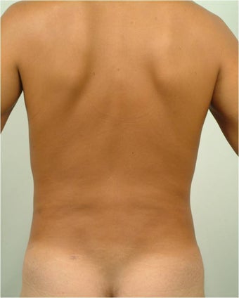Laser Liposuction 