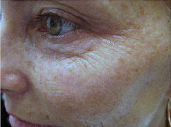 Fractional CO2 laser