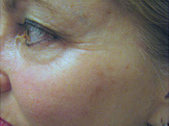 Fractional CO2 laser