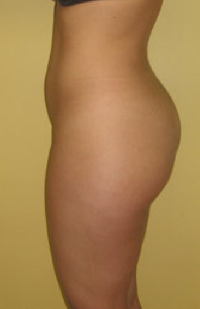 Buttock Augmentation