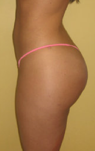 Buttock Augmentation