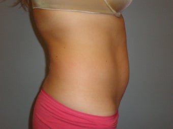 Mini Tummy Tuck 
