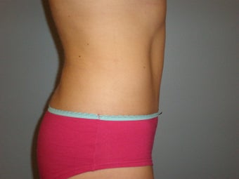 Mini Tummy Tuck 