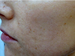Fractional laser used to treat acne scars