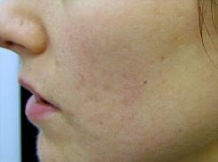 Fractional laser used to treat acne scars
