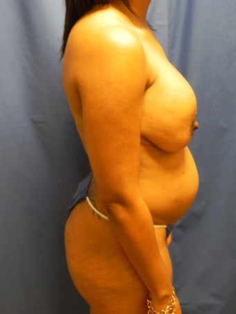 Revision Breast Augmentation and Mastopexy