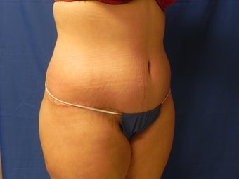 Body Lift