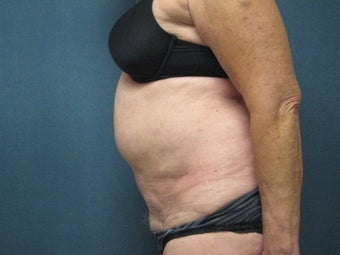 Smartlipo of the Abdomen