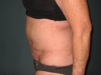 Smartlipo of the Abdomen