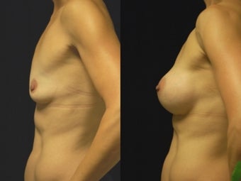Breast augmentation, gel implants