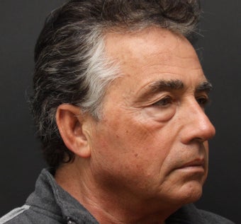 Upper and Lower Belpharoplasty