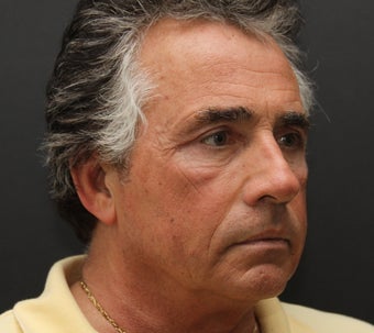 Upper and Lower Belpharoplasty