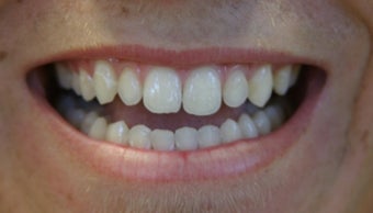 porcelain bridge with veneers replacing teeth
