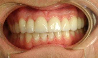 porcelain bridge with veneers replacing teeth
