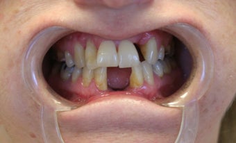 smile make over