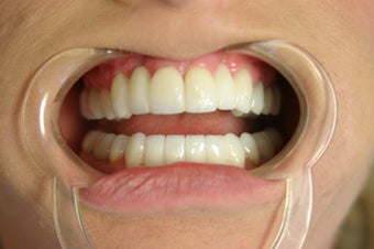 smile make over