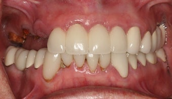 Dental implants and PFM bridge