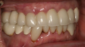 Dental implants and PFM bridge