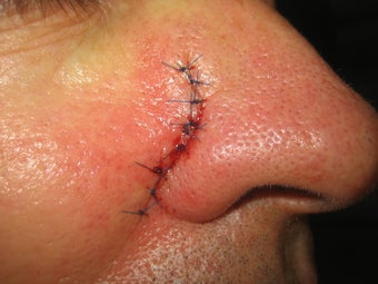 Mohs Surgery