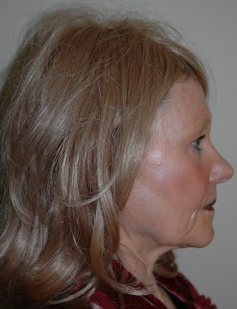High SMAS Face Lift, Neck Lift, Perioral Dermabrasion