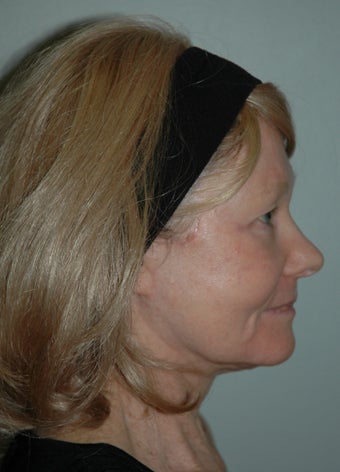 High SMAS Face Lift, Neck Lift, Perioral Dermabrasion