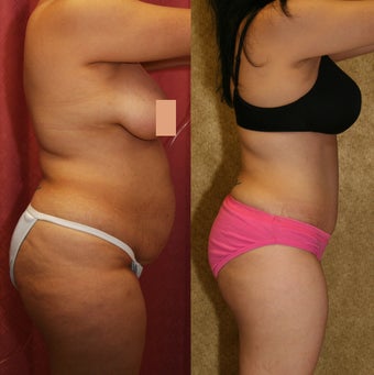 abdominoplasty- tummy tuck