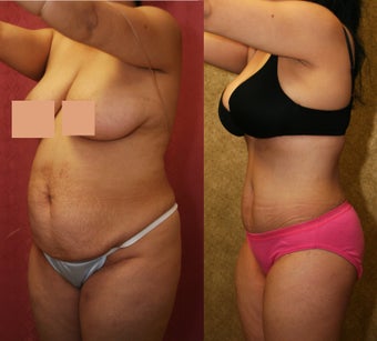 abdominoplasty- tummy tuck