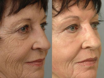 Deep Peel