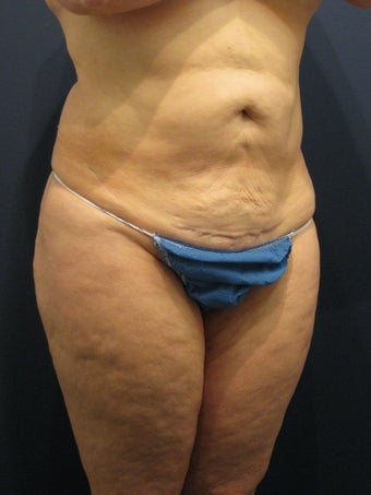 Abdominoplasty