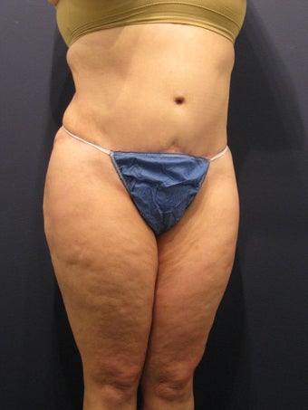 Abdominoplasty