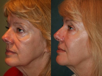 Sculptra