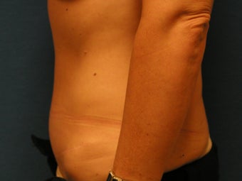 Abdominoplasty