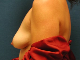 Mastopexy and Breast Augmentation