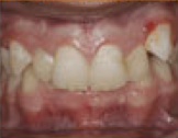 Damon System Braces