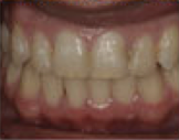 Damon System Braces