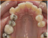 Damon System Braces