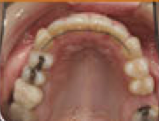 Damon System Braces