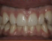 Damon System Braces