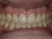 Damon System Braces