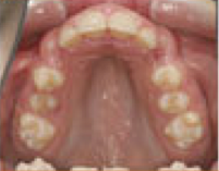 Damon System Braces