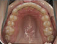 Damon System Braces