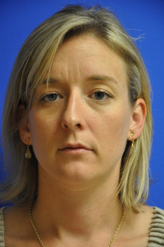 Nasal airway surgery with cosmetic improvment