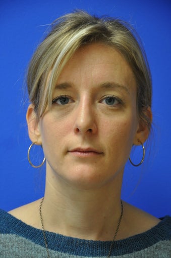 Nasal airway surgery with cosmetic improvment