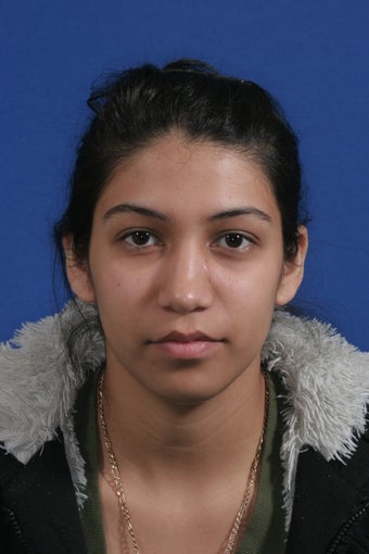 nasal airway surgery with cosmetic benefits