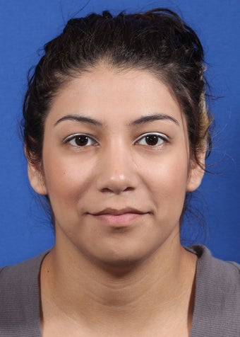 nasal airway surgery with cosmetic benefits